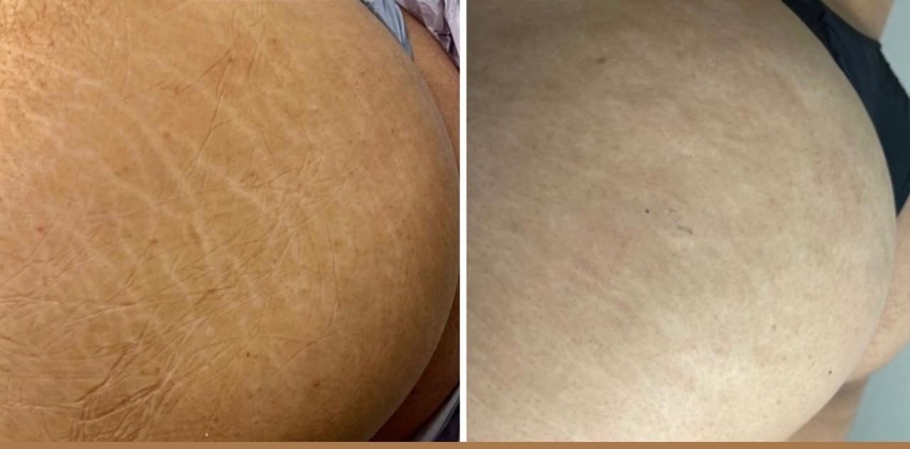 Antes e depois — Estrias na lateral do corpo