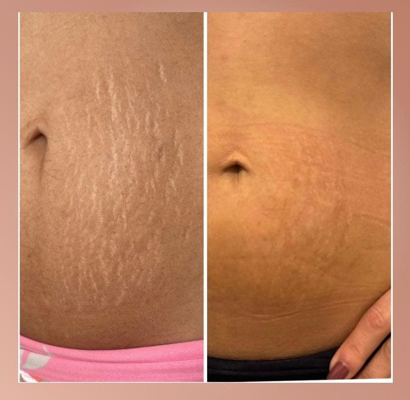Antes e depois — Estrias no abdômen