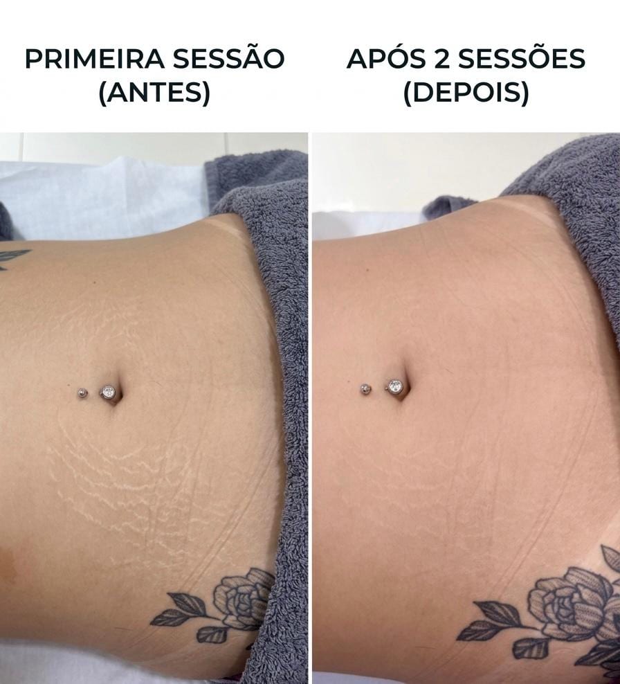 Antes e depois — Estrias no abdômen · após 2 sessões